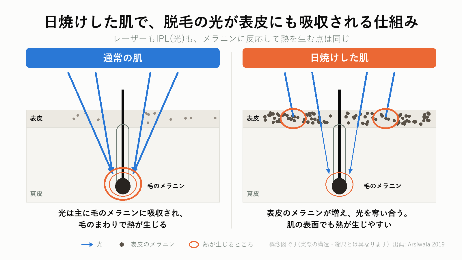 日焼けした肌で脱毛の光が表皮にも吸収される仕組み