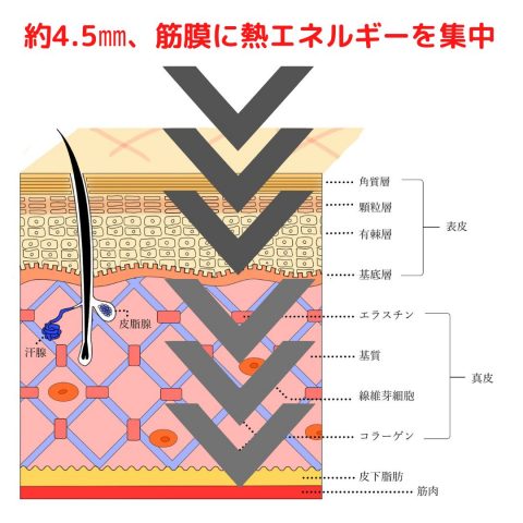 【ハイフはやめたほうがいいの?】5つの理由と効果を解説!ハイフとは