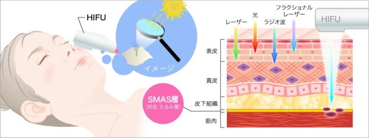 ハイフをすると将来たるむ?ハイフのメリット・デメリットを徹底解説!